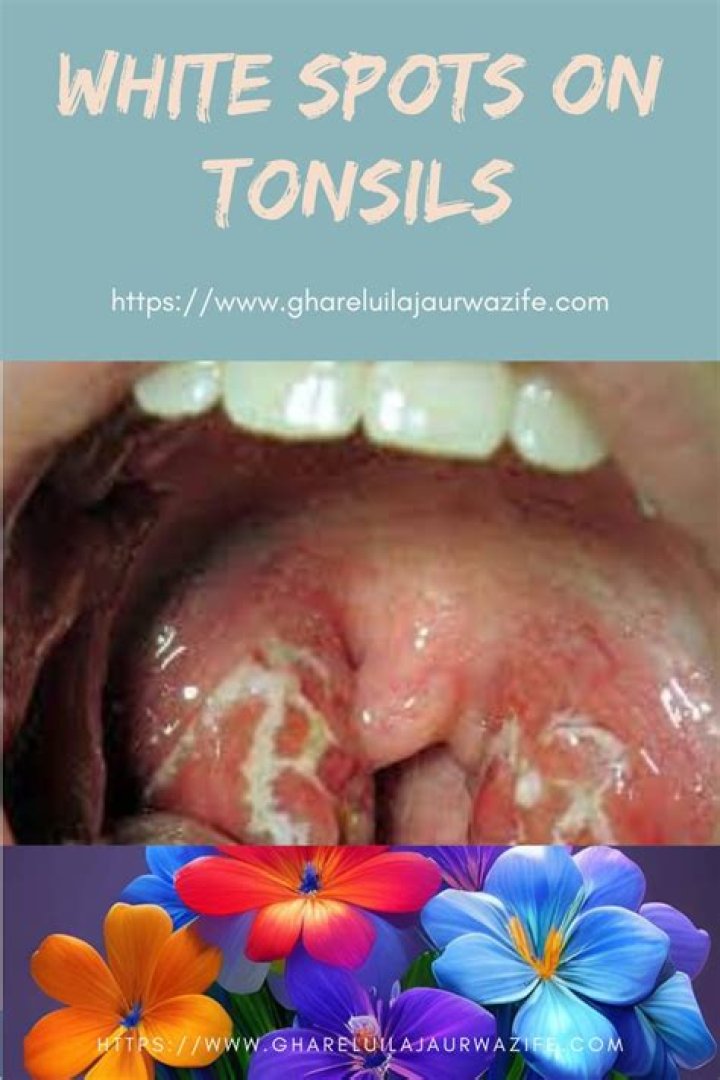 Why do I have white spots on one tonsil?