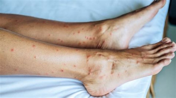 Why do I keep getting bites on my lower legs?