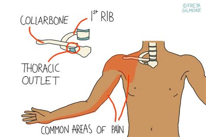 Why does my thoracic outlet hurt?
