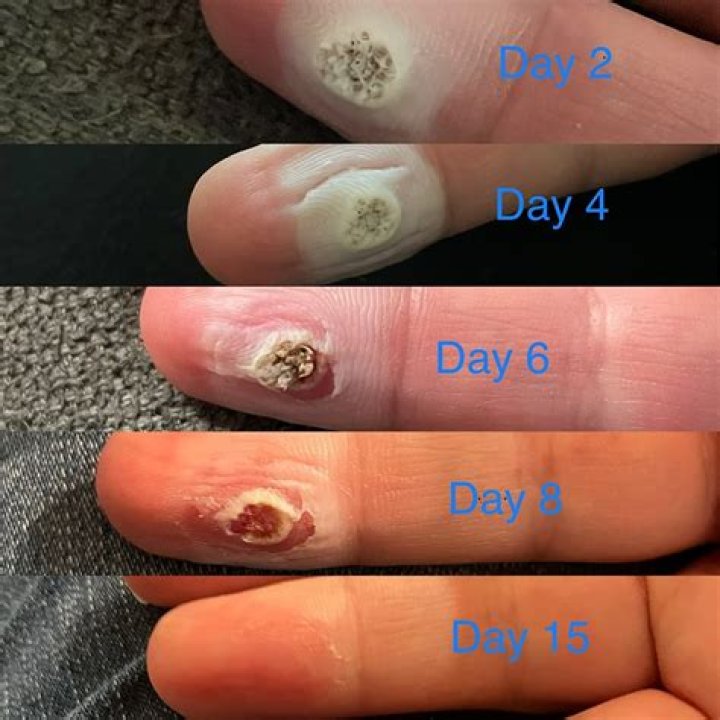 Why does wart remover turn white?