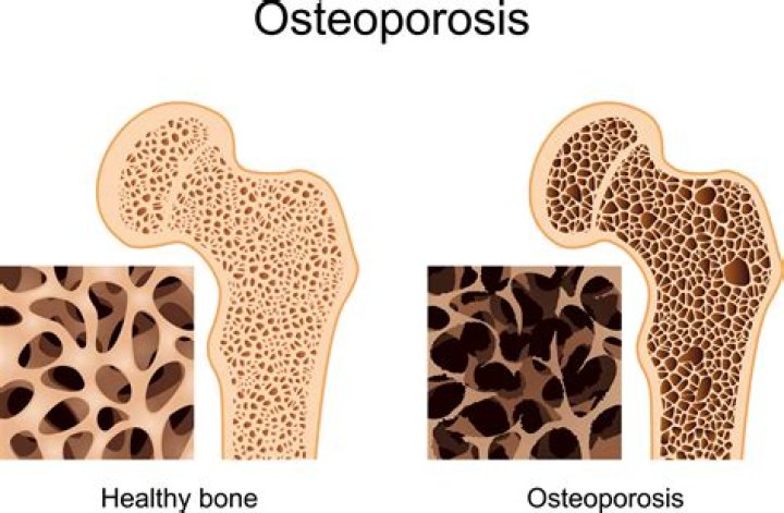 Why is osteoporosis serious?
