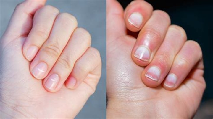 Why is the area around my nails red?