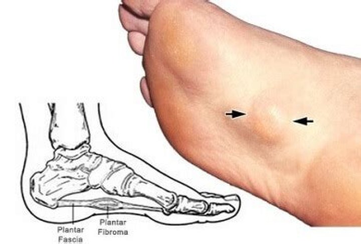 Why is there a bump on my foot near my ankle?